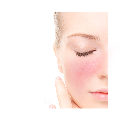 Rosacea, rosaceás bőr